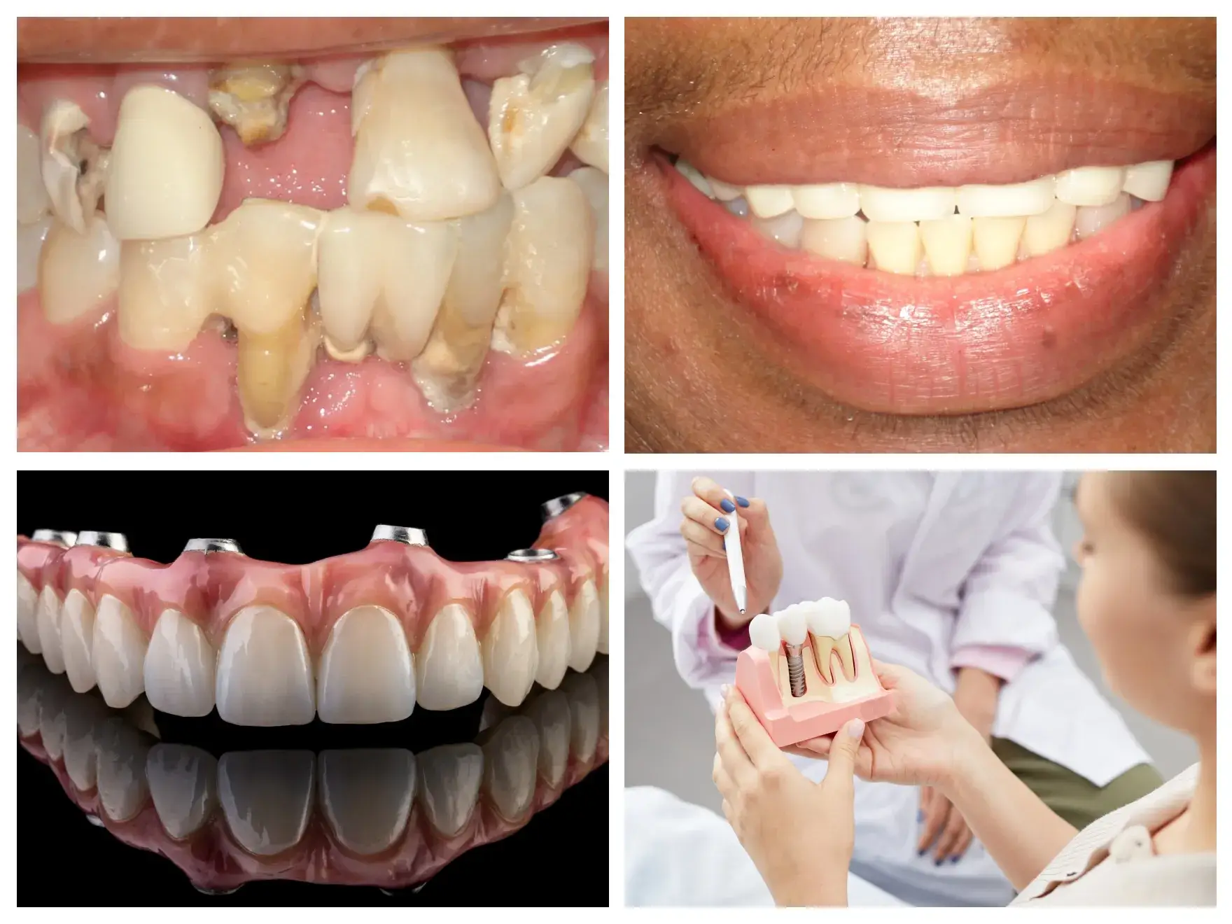 Collage showing diseased teeth, a smiling person with uneven teeth, a dental implant denture, and a dentist explaining a tooth implant model to a patient.